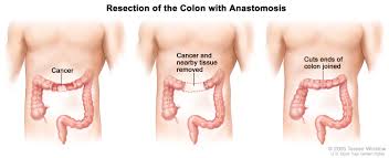 This is a challenging cancer to find early and treat. Colon Cancer Hematology Oncology Associates Of Cny