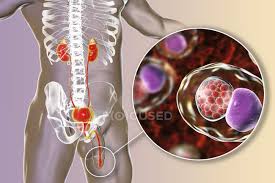 Ilustración digital de silueta masculina con frotis uretral que muestra  infección por clamidia con bacterias Chlamydia trachomatis . ? Infectar,  anatomía - Stock Photo | #225656918