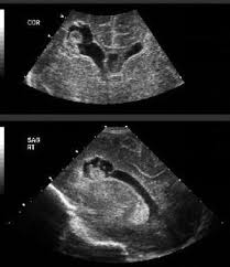 Periventricular Hemorrhage Intraventricular Hemorrhage Background Pathophysiology Epidemiology Ultrasound Diagnostic Medical Sonography Ultrasound Tech