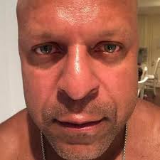 Exosome therapy los angeles