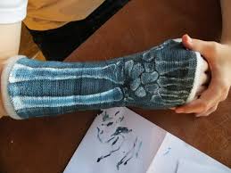 X Ray Painted Cast Castlife Drypro Castart Www Drycorp Com Arm Cast Cast Art Arm Art