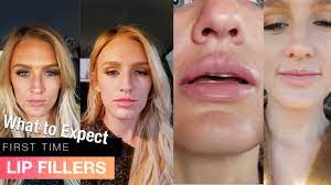 She received 4 syringes of voluma to … My First Time Getting Lip Fillers Before And After 1 Syringe Juvederm Ultra Youtube
