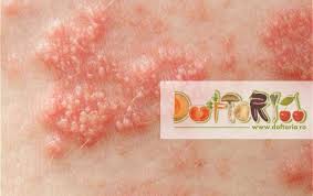 Zona zoster apare la persoanele care au avut varicelă în tinerețe, de regulă în copilărie. Zona Zoster Doftoria Ro