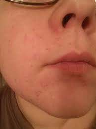 Stare at the red dot on the caps's nose for 30 seconds. Red Little Needlepoints On My Face Babycenter