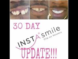 Instasmile 30 Day Update Q A Youtube 30 Day Dental