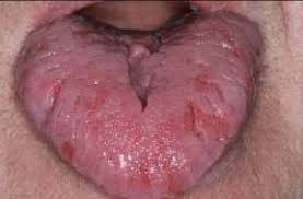 Image result for Fissured tongue