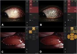 evaluating a new objective grading software for conjunctival