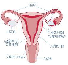 Our goal is to improve awareness and enhance. Endometriose Von Der Diagnose Bis Zur Symptomlinderung Natracare