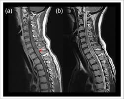Jul 10, 2021 · mit hilfe einer psychiatrischen tagesklinik gelang es mir in ca. Longitudinally Extensive Transverse Myelitis Lesion C5 T1 In Download Scientific Diagram