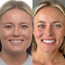 Collaboration at its finest!!! @rccornell has been my patient for several  years now. A couple years ago she asked me about the possibility of getting  veneers done. I told her at the