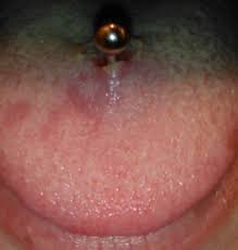 If you notice symptoms like excessive swelling, piercing pain, redness or tongue discoloration, contact your doctor immediately. Tongue Piercing Procedure Healing Aftercare Cost Pictures