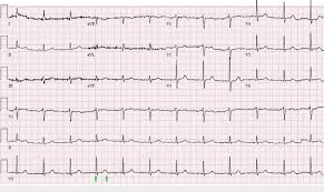 Review the ecg (ekg), present it according to the structure in ecg interpretation and attempt a diagnosis before clicking on the plus symbol to see the answer. Ekg Showing Resolution Of The Bradycardia And Restoration Of Normal Qtc Download Scientific Diagram