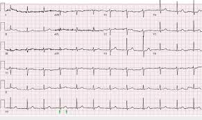 Subscribe to litfl via email. Ekg Showing Resolution Of The Bradycardia And Restoration Of Normal Qtc Download Scientific Diagram