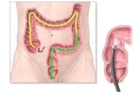 Der arzt erkennt polypen bei der darmspiegelung ( endoskopie : Https Www Endoskopie Loerrach De Wp Content Uploads 2019 10 Endoskopie Aufklaerung Koloskopie Pdf