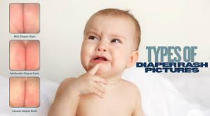 Image result for diaper dermatitis