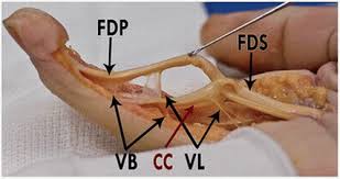 Occupational therapist discusses function of fds and fdp tendons Zone Ii Flexor Tendon Repair Musculoskeletal Key