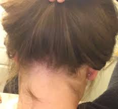 There are incredible top of head hair thinning. 21 Year Old Female With Thin Hair On Top Of My Head Since I Was 16 Met With A Dermo In High School Photos