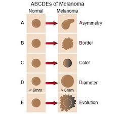 But don't ignore a bump if. Melanoma What You Need To Know