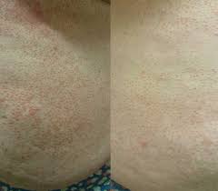 We did not find results for: Acd A Z Of Skin Pityriasis Rubra Pilaris