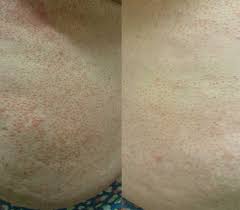 What is pityriasis rubra pilaris? Acd A Z Of Skin Pityriasis Rubra Pilaris