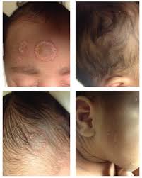 Image result for white scabs on the head in children