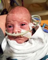 Have you experienced TTTS or sIUGR with identical twins?