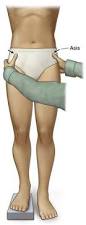 Image result for True Leg Length Discrepancy