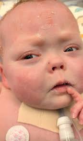 Amaya's NICU Journey and Upcoming Washout Procedure