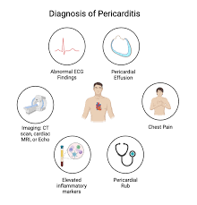 Image result for Post-MI Pericarditis