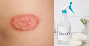 Has anyone used bleach to quickly treat their ringworm infection? How To Get Rid Of Ringworm With Bleach Bright Stuffs