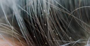 Image result for lice vs nits