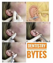 Image result for Ear Nerve Block
