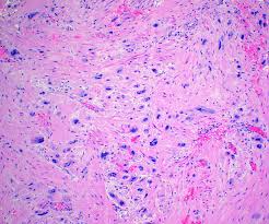 Benign multicystic peritoneal mesothelioma (bmpm) is a completely rare benign cystic tumor springing up from the peritoneal mesothelium (lining of. Soft Tissue Blog Pathologyoutlines Com