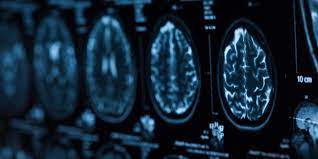 Aducanumab is a human monoclonal antibody that has been studied for the treatment of alzheimer's disease (ad). Rsbadqwd6l4s9m