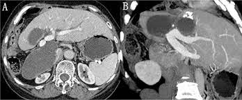 Developmental Anomalies Of The Right Hepatic Lobe Systematic Comparative Analysis Of Radiological Features