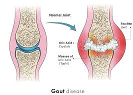 Image result for gout symptoms knee