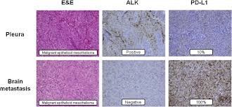 In its early stages, peritoneal mesothelioma generally does not spread beyond the peritoneal cavity, which contains the stomach, spleen, liver, intestines and other abdominal organs. Impressive Clinical Response To Anti Pd 1 Therapy In Epithelioid Mesothelioma With High Clonal Pd L1 Expression And Eml4 Alk Rearrangement Lung Cancer