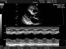 That is the tokyo otaku mode shop mission! Ultrasound Images Heart Amyloidosis M Mode 404 Sonoace X4