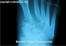 What is a charcot joint? Charcot Joints Causes And Treatment Options Myfootshop Com