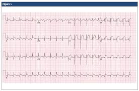 Image result for ST Elevation