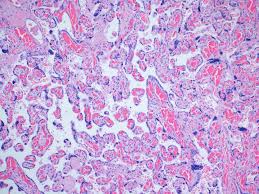 Vaccination of pregnant people and lactating people actually leads to transfer of some immunity to their newborns and lactating infants, said dr. Covid 19 Vaccine Does Not Damage The Placenta In Pregnancy Eurekalert Science News