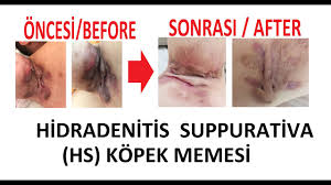 Kopek Memesi Hidradenitis Suppurativa Hs Hastaligi Bitkisel Tedavisi Oncesi Before Sonrasi After Youtube