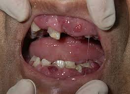 Facebook fundraising see child pages of facebook fundraising. Acute Myeloid Leukemia Wikipedia