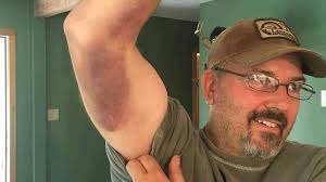 HSS Lifeline Saves Rob Kaufhold's Life