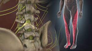 Radiculopathy Johns Hopkins Medicine