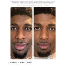 Collagen Transformation 74