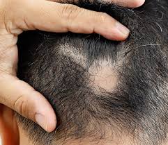 Image result for Alopecia