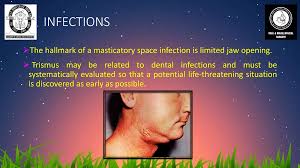 Image result for Trismus