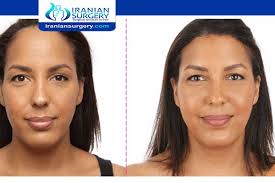 How can i lower my forehead? Forehead Reduction Without Surgery Forehead Reduction Iranian Surgery