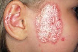 Selain itu,kawasan kulit tersebut turut berasa gatal. Psoriasis Di Muka Penyebab Gejala Diagnosis Rawatan Komprehensif Mengenai Kesihatan Di Ilive